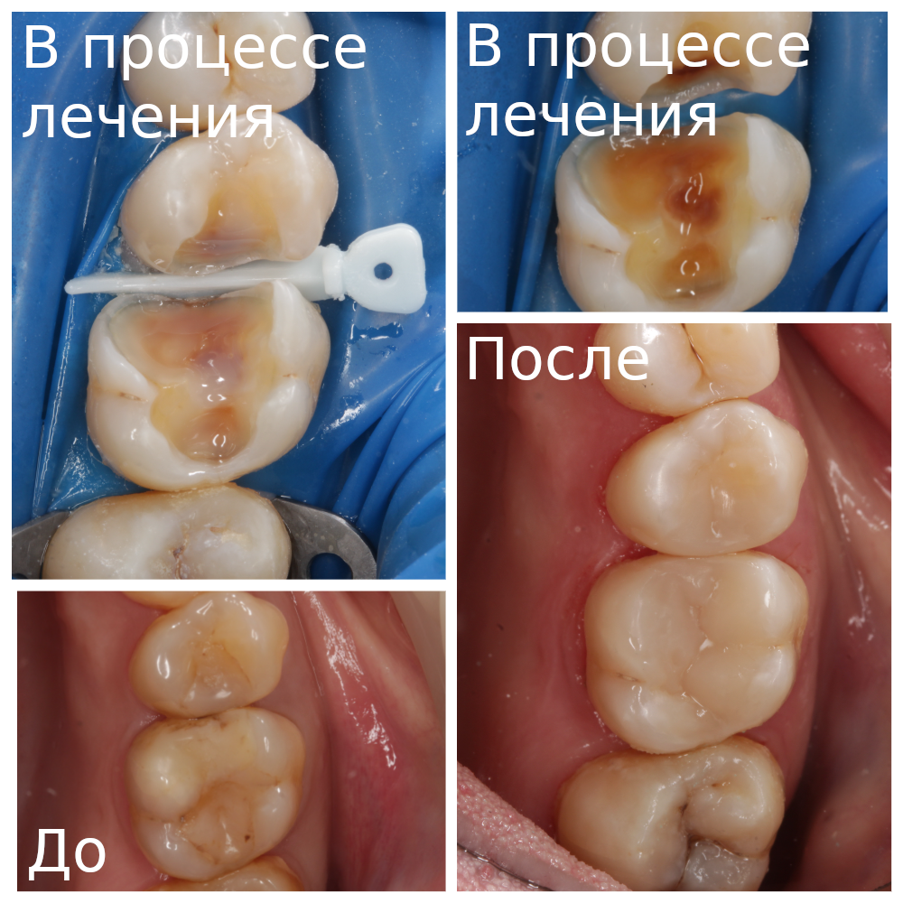 Лечение зубов под микроскопом